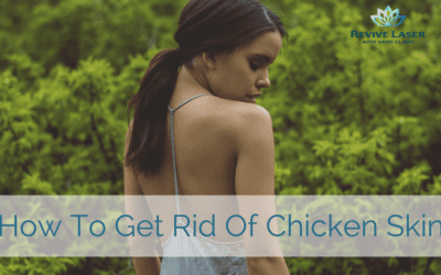 Keratosis Pilaris (aka Chicken Skin) – How to get rid of it