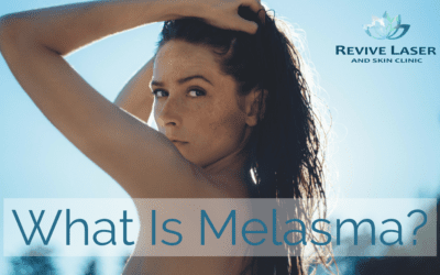 What is Melasma?