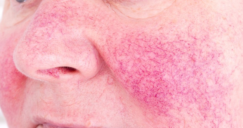 facial rosacea - Revive Laser