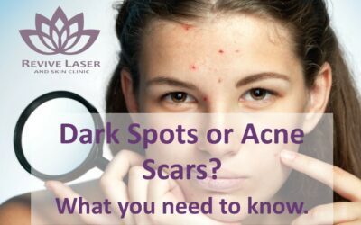 Acne Scars or Dark Spots?