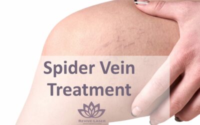 Laser Vein Treatment