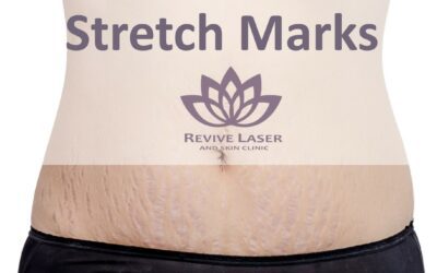 Stretch Marks